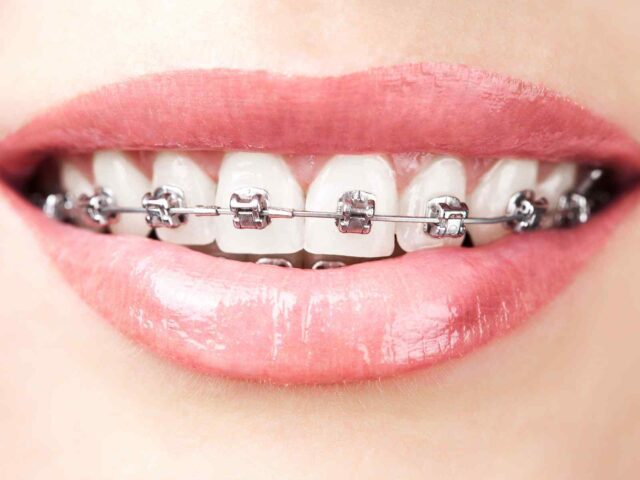 Invisalign braces