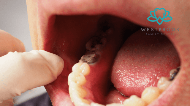 Dental Crowns and Bridges