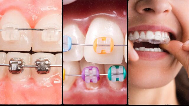 Common Orthodontic Treatments