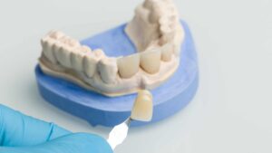 Dental Veneers