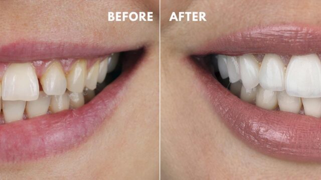 Benefits of Dental Veneers