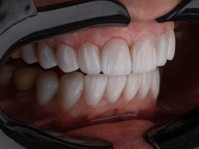 a person's mouth with teeth