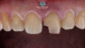 Chipped Teeth