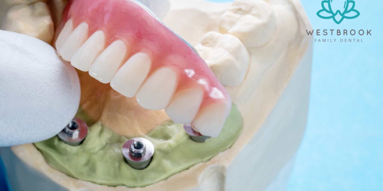 Affordable Full Mouth Dental Implants in QLD Australia