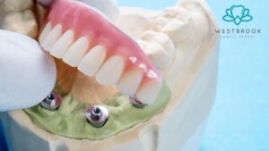 Full Mouth Dental Implants