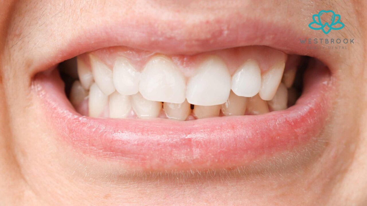 Teeth Misalignment