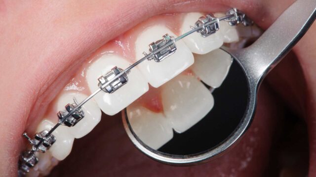 Orthodontic Evaluations