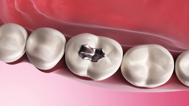 Tooth-Colored Fillings