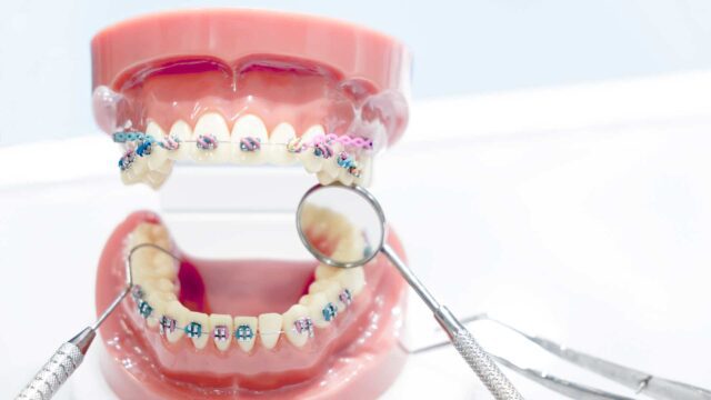 Orthodontic Treatment