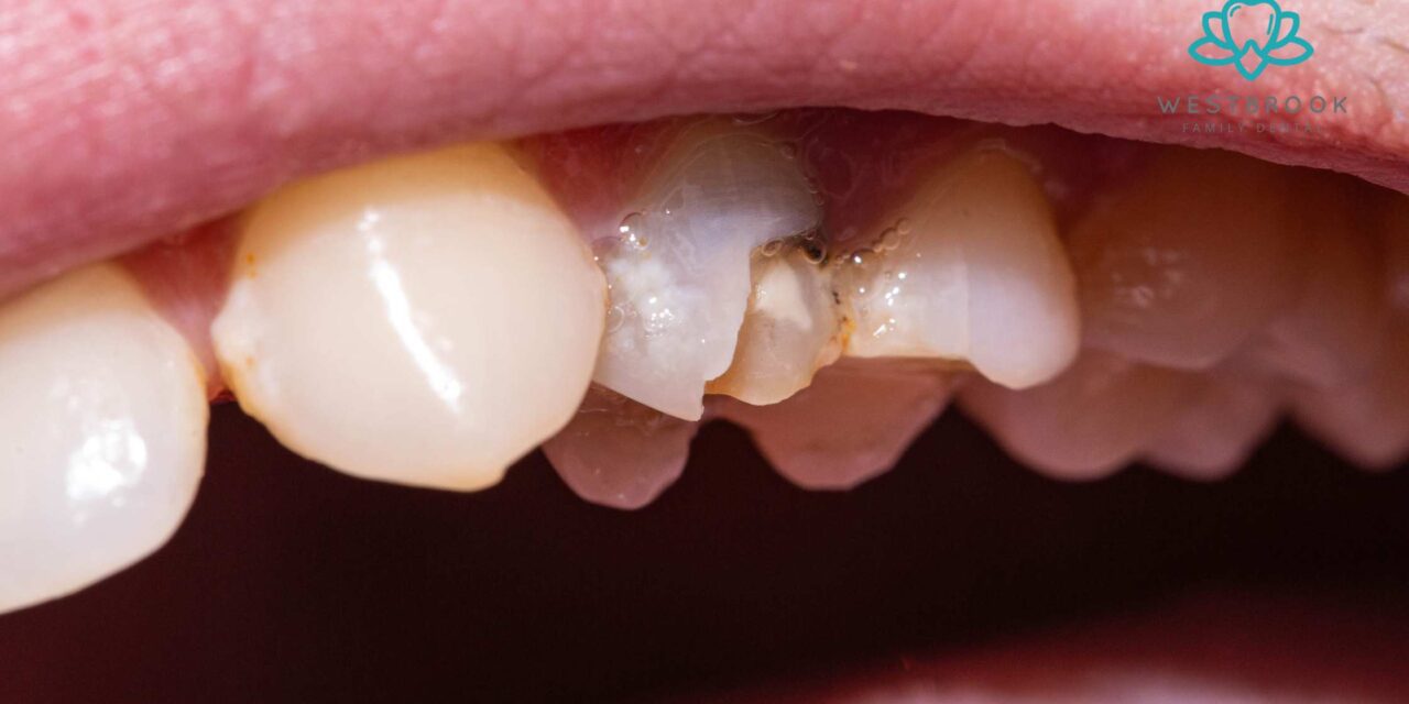 What Is the Best Customized Treatment Option for a Chipped Tooth?