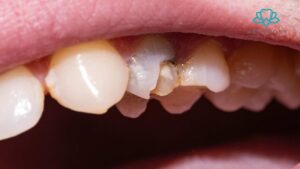 Chipped Tooth