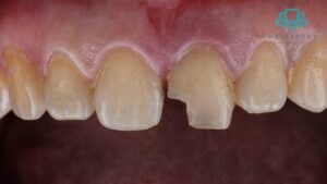 chipped tooth