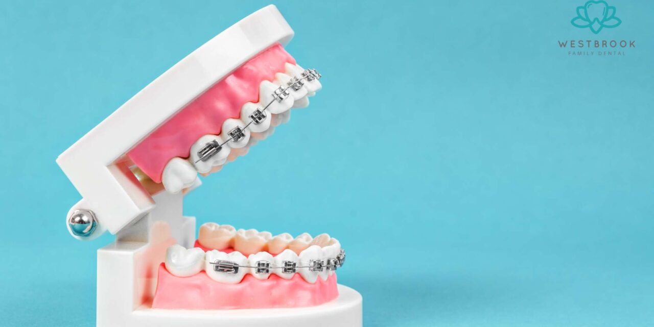 Are Teeth Braces the Best Solution for Misaligned Teeth?