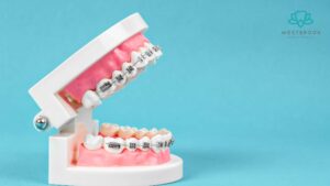 Misaligned Teeth