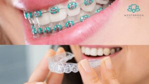 Invisible Braces