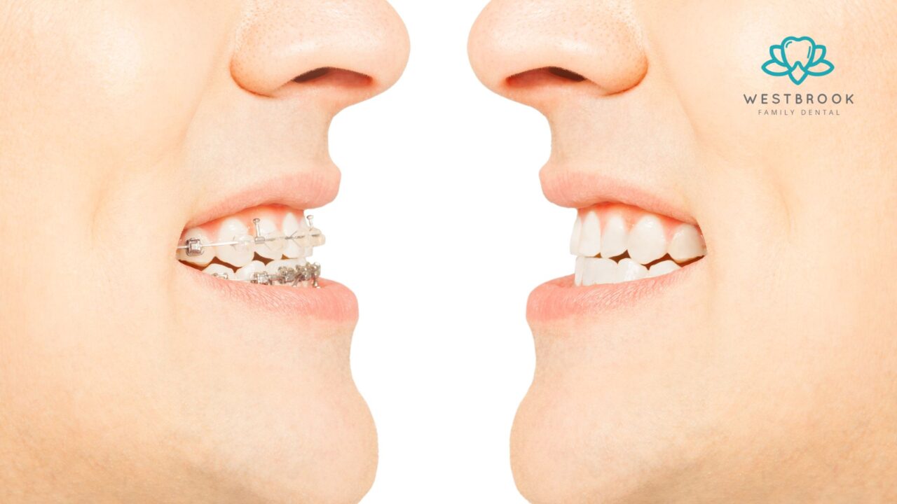 Braces vs. Aligners