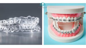 Teeth Braces Invisible vs. Traditional Braces: Which One is Right for You?