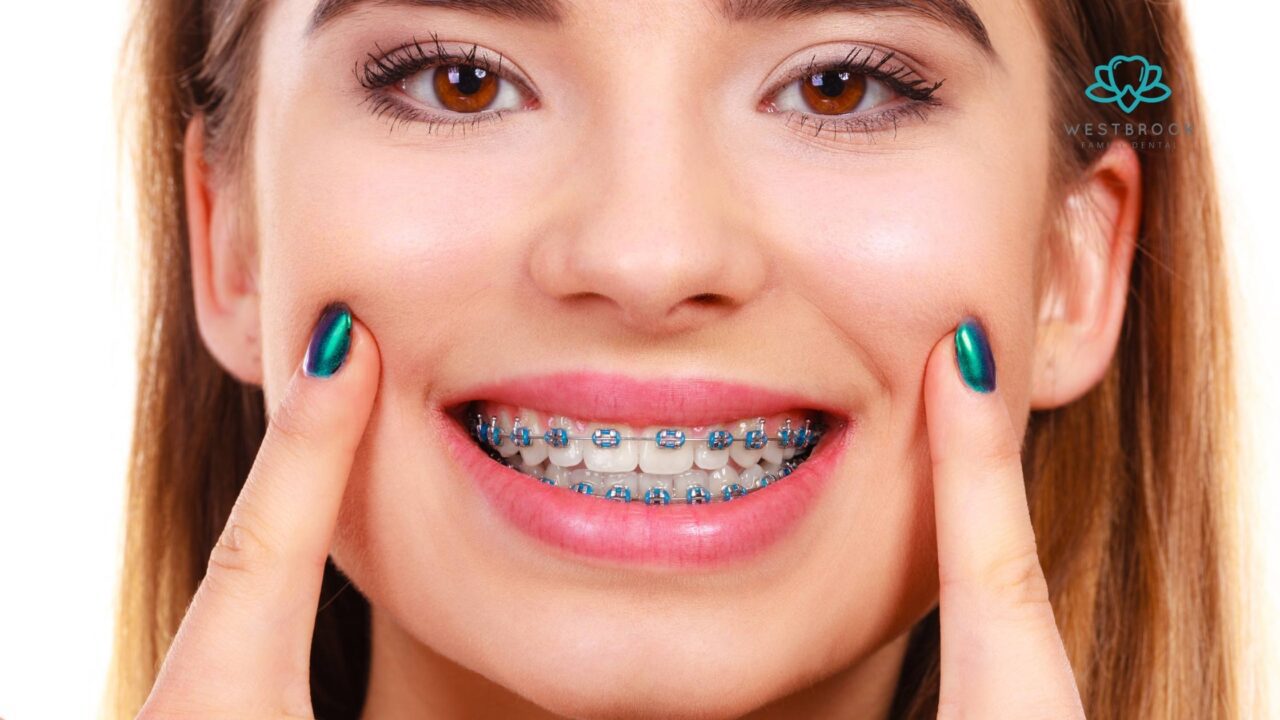 Traditional Braces