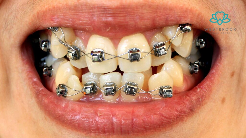 Common Myths About Teeth Braces for Adults – Debunked! Teeth Braces for Adults
