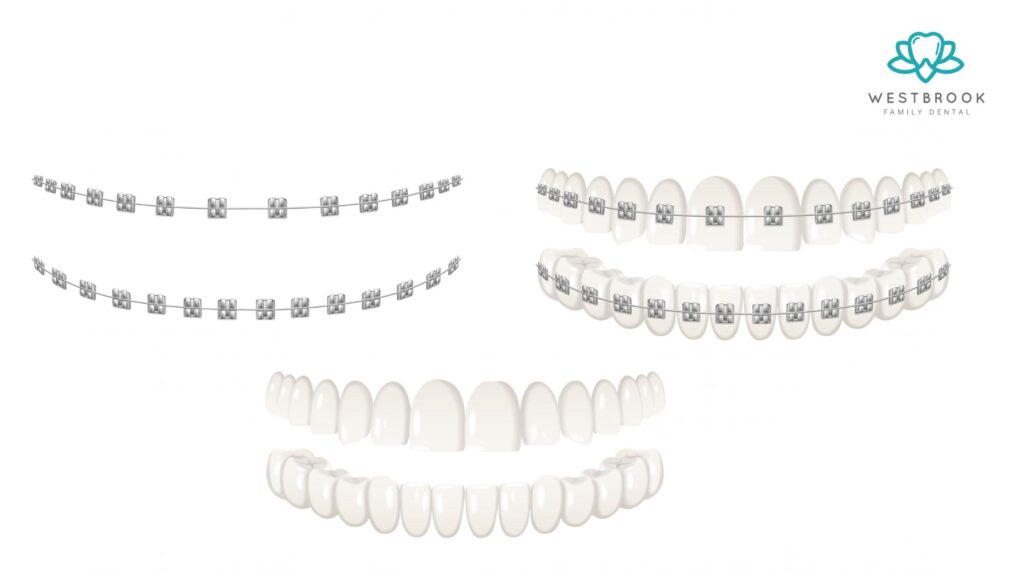 Teeth Braces White: The Discreet Way to Straighten Your Smile Westbrook Dental