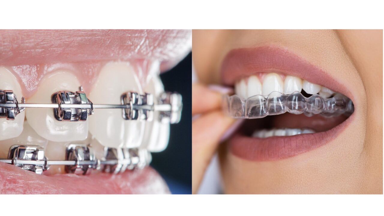 Types of Teeth Braces