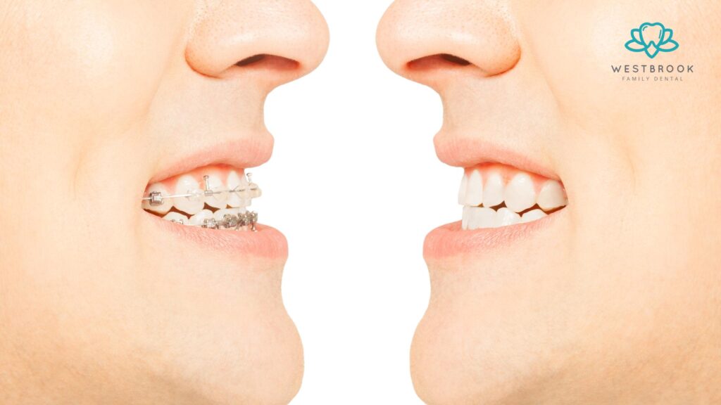 Teeth Braces White: The Discreet Way to Straighten Your Smile Westbrook Dental