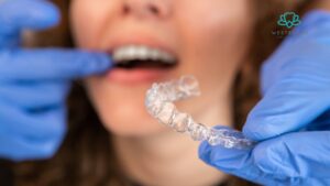 Invisalign on Teeth