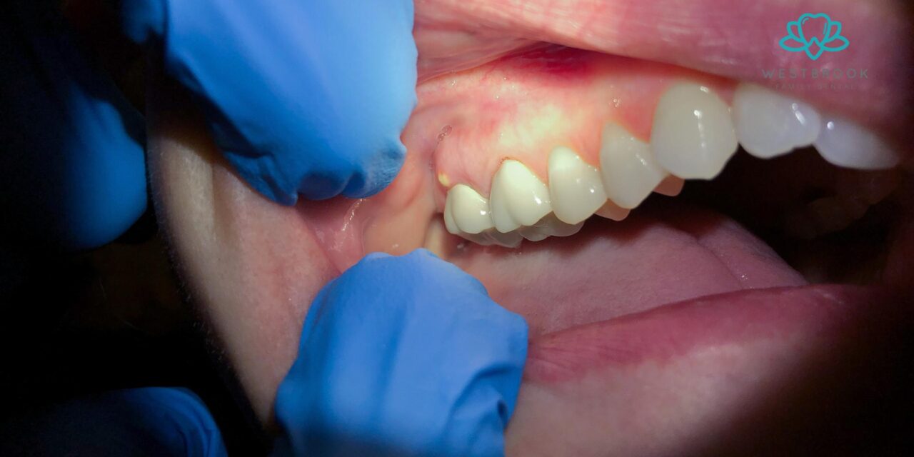 Recognising the Early Signs of a Tooth Abscess and How to Respond