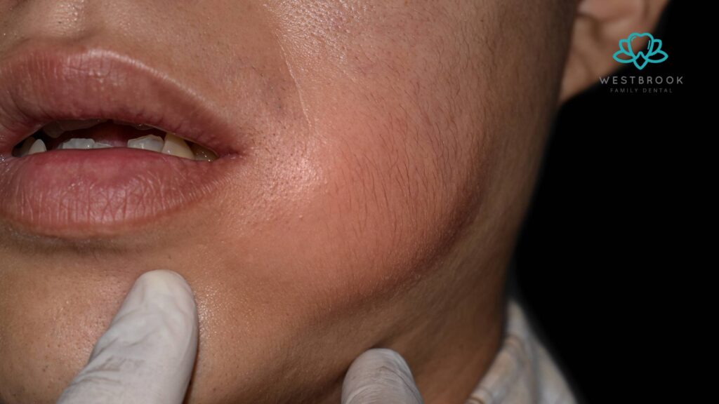 Tooth Abscess and Your Health: Why Prompt Dental Care Is Critical Westbrook Dental
