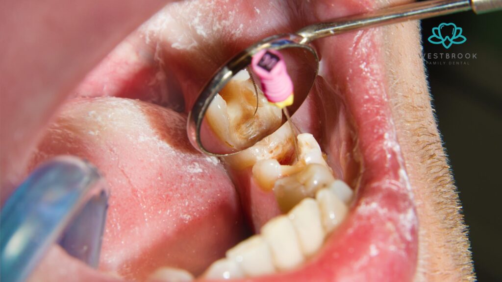 Recognising the Early Signs of a Tooth Abscess and How to Respond Westbrook Dental