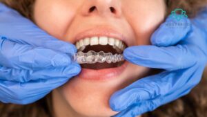 Invisalign on Teeth