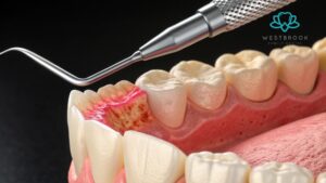 Gum Disease
