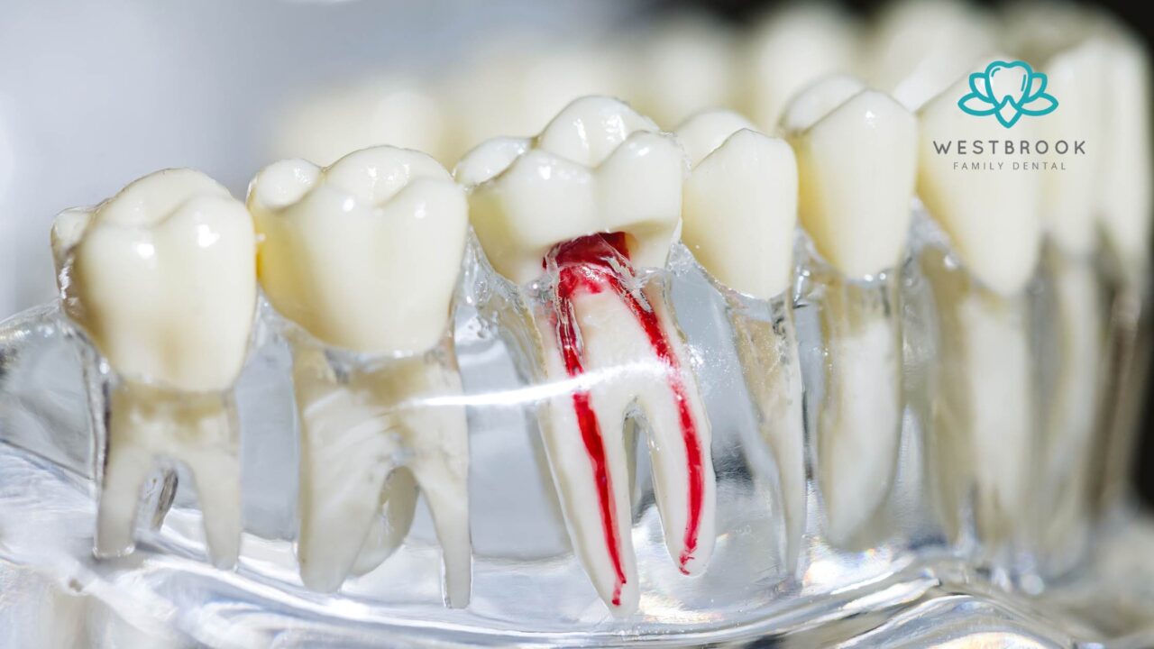 Root Canal