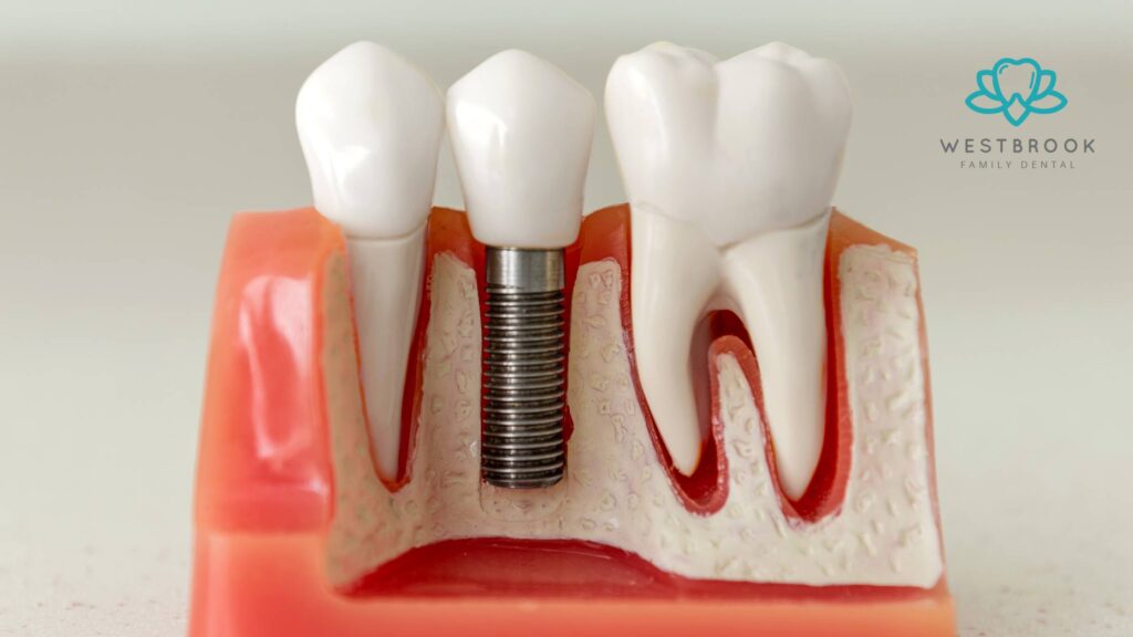 Best Dental Implants