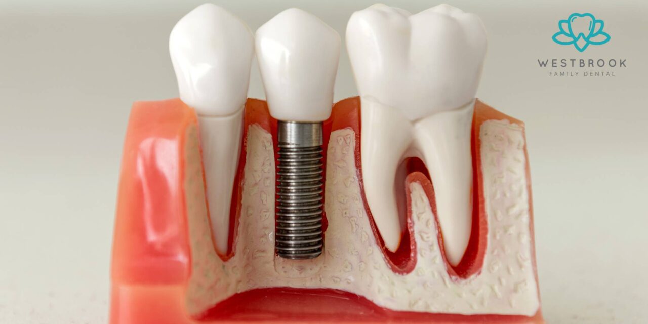 The Ultimate Guide to Finding the Best Dental Implants in Toowoomba