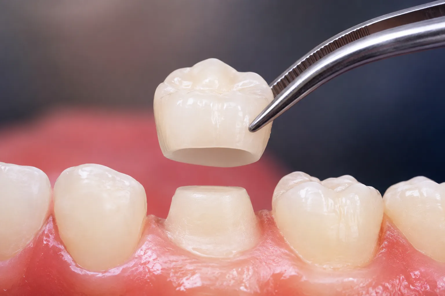 Chipped Tooth Westbrook Dental